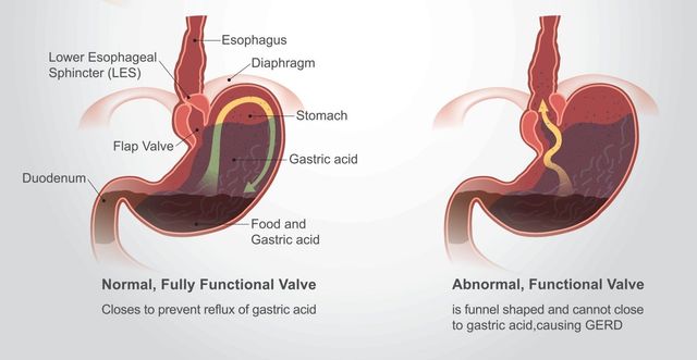 Can Acid Reflux Affect the Nose